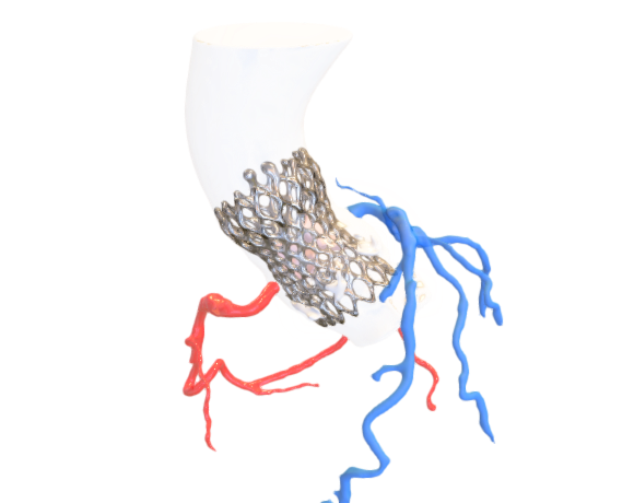 Segmentation_TAVI_MarcoMoscarelli