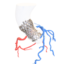 Segmentation_TAVI_MarcoMoscarelli